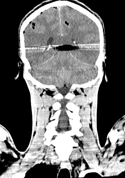 File:Arrow injury to the brain (Radiopaedia 72101-82607 Coronal non-contrast 52).jpg