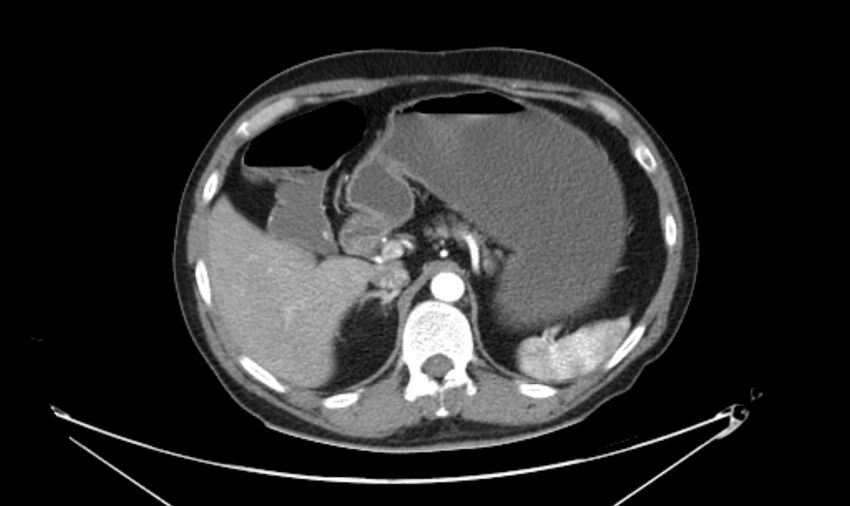 Arterial occlusive mesenteric ischemia (Radiopaedia 84641-100060 A 42).jpg