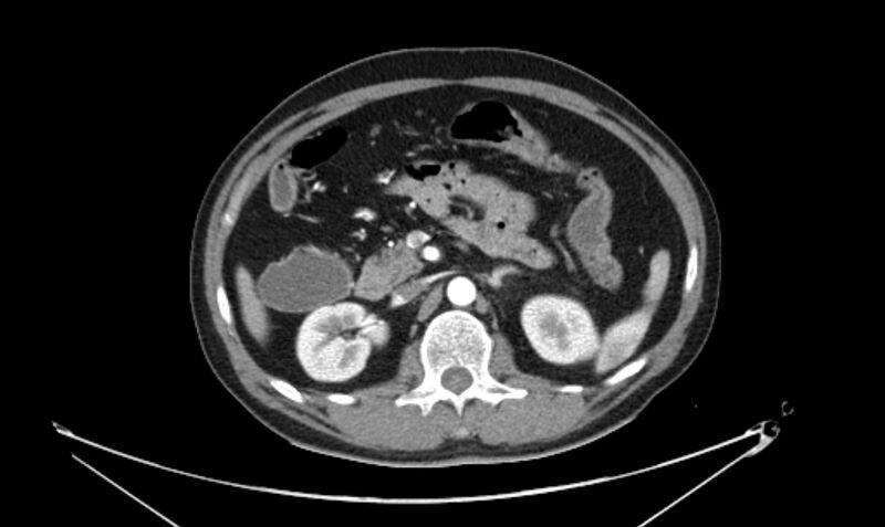 File:Arterial occlusive mesenteric ischemia (Radiopaedia 84641-100060 A 53).jpg