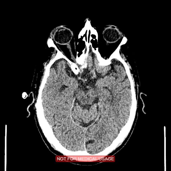 File:Artery of Percheron infarction (Radiopaedia 28679-28967 Axial non-contrast 45).jpg