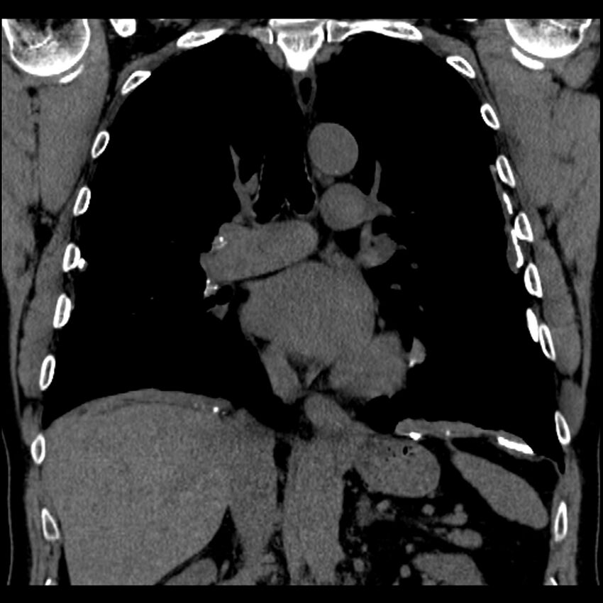 Asbestos-related pleural plaques (Radiopaedia 39069-41255 Coronal non-contrast 42).jpg