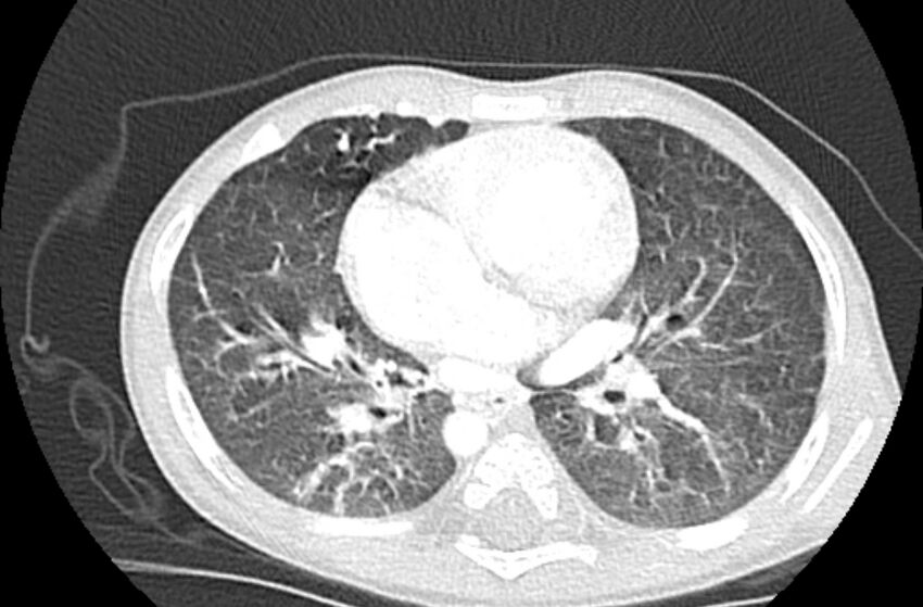 Asplenia syndrome (Radiopaedia 73083-83792 Axial lung window 39).jpg