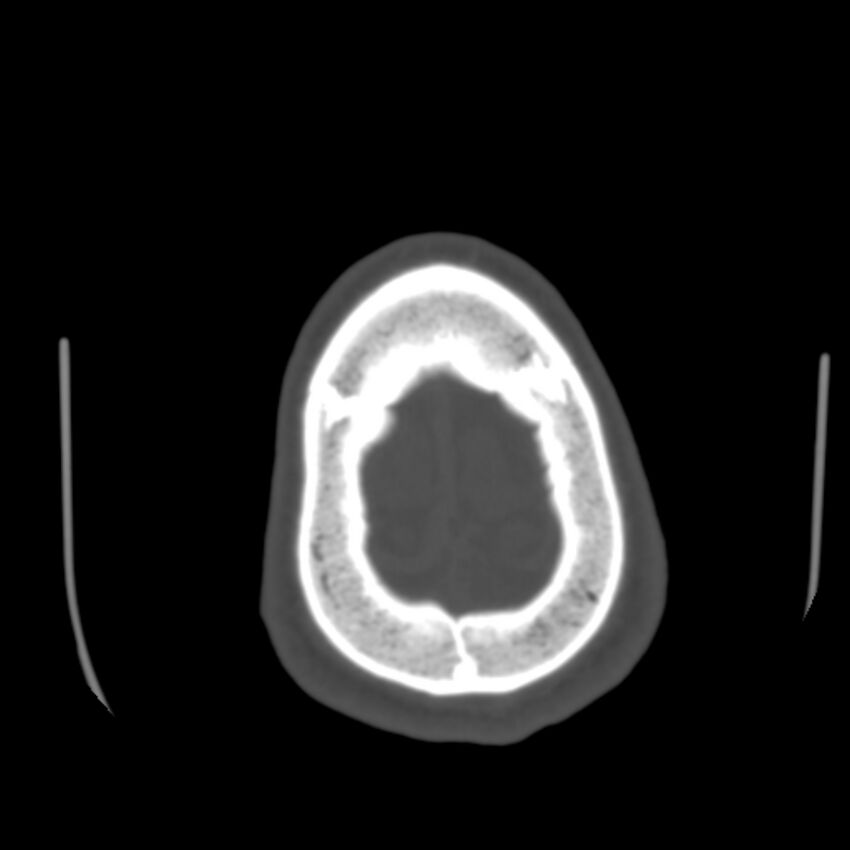 Asymptomatic occipital spur (Radiopaedia 87753-104201 Axial bone window 197).jpg
