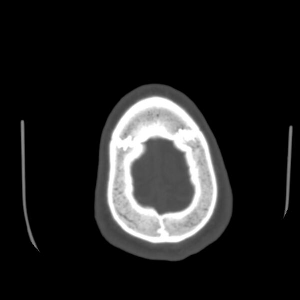 File:Asymptomatic occipital spur (Radiopaedia 87753-104201 Axial bone window 199).jpg