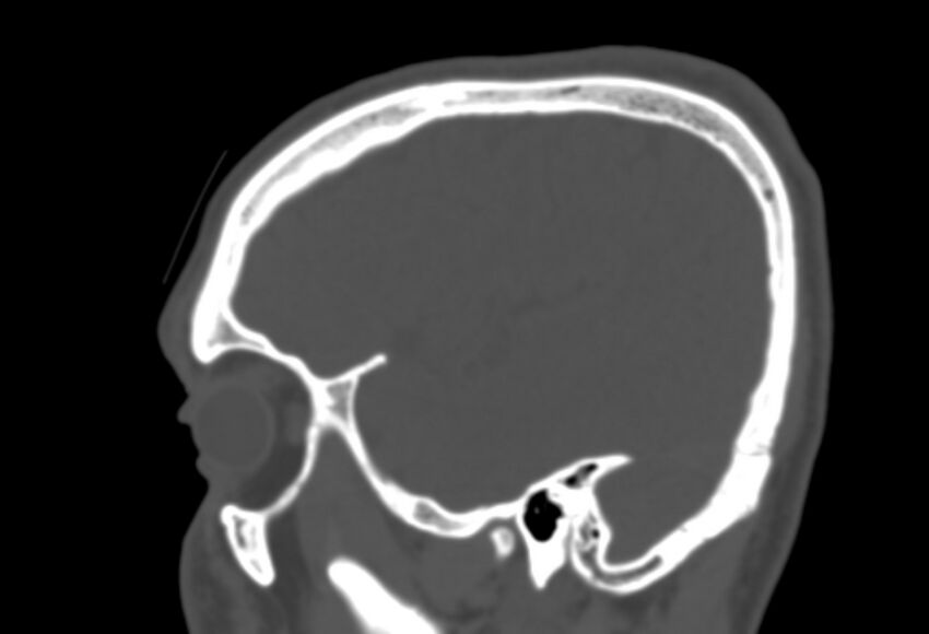 Asymptomatic occipital spur (Radiopaedia 87753-104201 Sagittal bone window 58).jpg