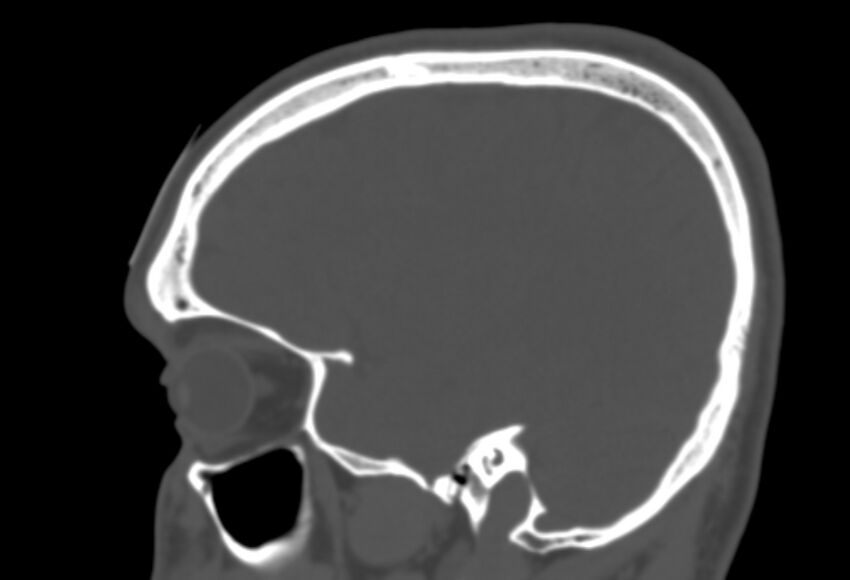 Asymptomatic occipital spur (Radiopaedia 87753-104201 Sagittal bone window 80).jpg