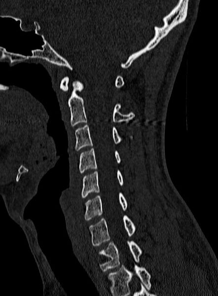 File:Atlantoaxial subluxation (Radiopaedia 44681-48450 Sagittal bone window 59).jpg