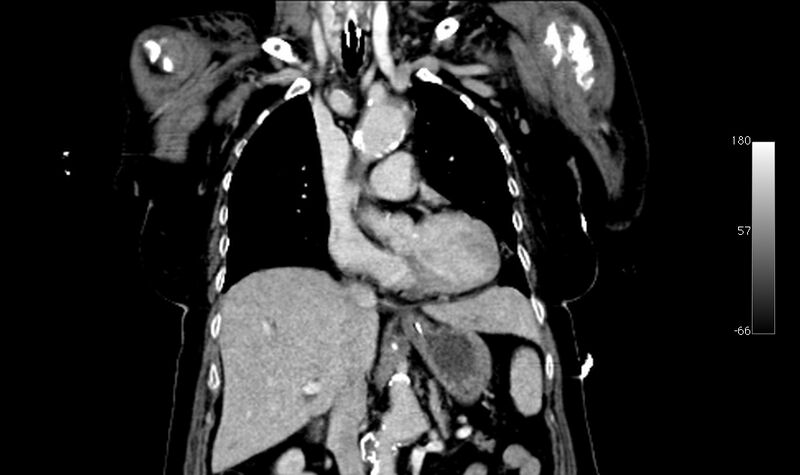File:Atypical dissection of the thoracic aorta (Radiopaedia 10975-78320 B 12).jpg