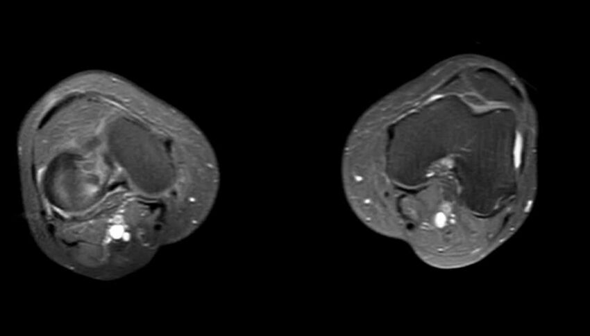 Atypical lipomatous tumor - thigh (Radiopaedia 68975-78734 Axial PD fat sat 8).jpg