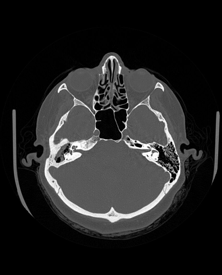 Automastoidectomy with labyrinthine fistula (Radiopaedia 84143-99411 Axial non-contrast 90).jpg