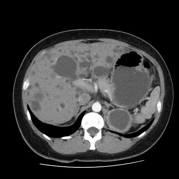 File:Autosomal dominant polycystic kidney disease (Radiopaedia 23061-23093 B 19).jpg