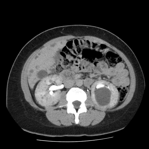 File:Autosomal dominant polycystic kidney disease (Radiopaedia 23061-23093 C+ delayed 33).jpg