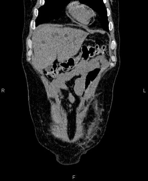 File:Autosomal dominant polycystic kidney disease (Radiopaedia 87830-104287 Coronal non-contrast 4).jpg