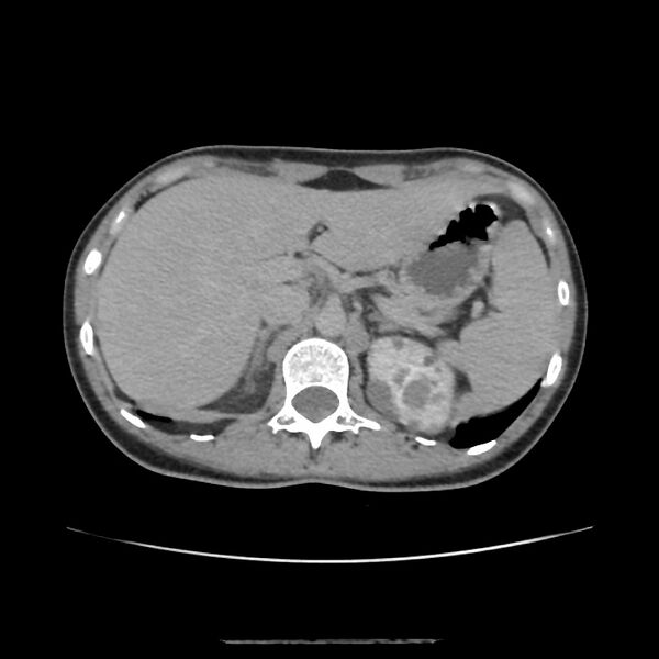 File:Autosomal dominant polycystic kidney disease - early onset (Radiopaedia 40734-43387 D 1).jpg