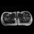 Avascular necrosis of the hip (Radiopaedia 29563-30067 Axial T2 17).jpg