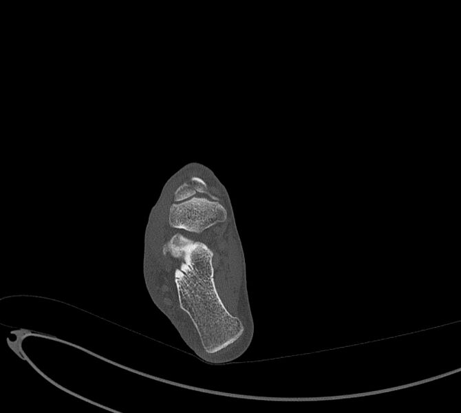 File:Avulsion fractures of talus and calcaneus (Radiopaedia 48277-53155 Axial bone window 65).jpg