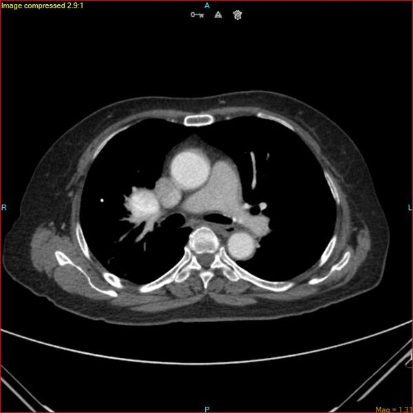 File:Azygos vein aneurysm (Radiopaedia 77824-90130 B 28).jpg