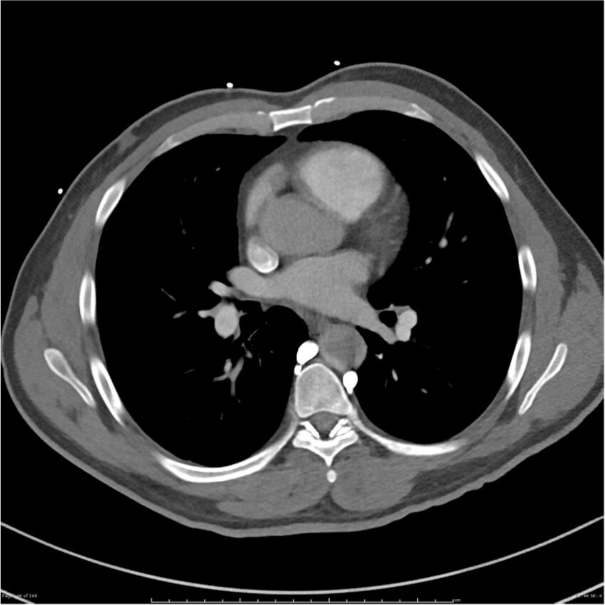 Azygos venous system anatomy (CT pulmonary angiography) (Radiopaedia 25928-26077 Axial C+ CTPA 46).jpg