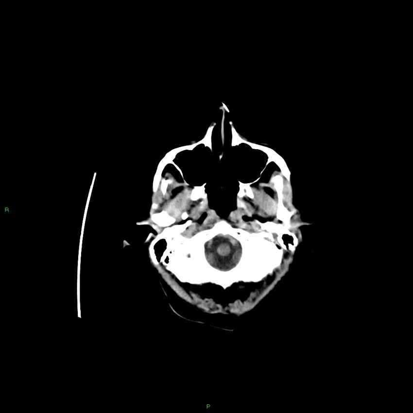 Basal ganglia hemorrhage (Radiopaedia 58350-65473 Axial non-contrast 42).jpg