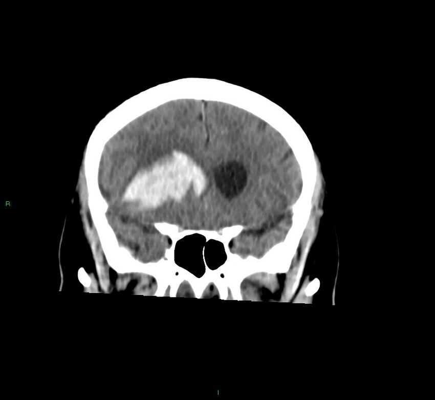 Basal ganglia hemorrhage (Radiopaedia 58763-65985 Coronal non-contrast 49).jpg