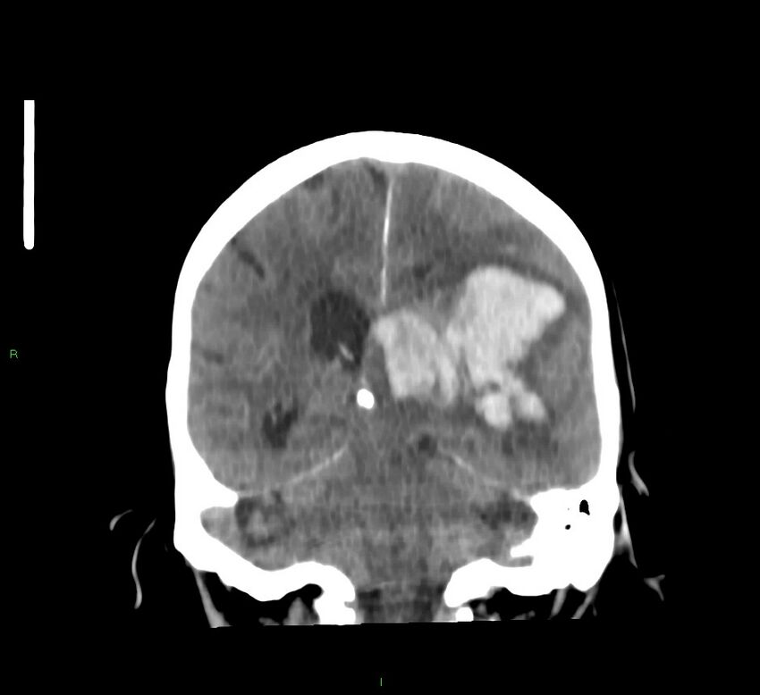 Basal ganglia hemorrhage (Radiopaedia 58767-65989 Coronal non-contrast 29).jpg