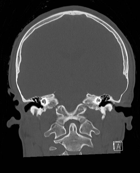 File:Base of skull fracture with bilateral Le Fort fractures (Radiopaedia 47094-51638 Coronal bone window 44).jpg