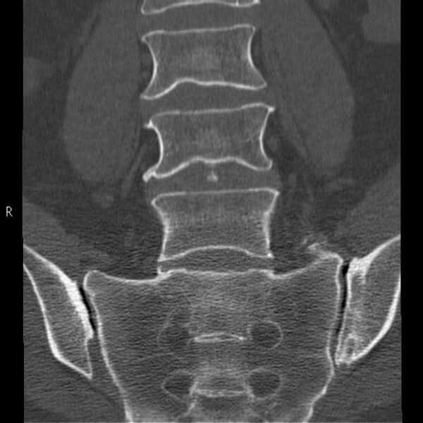 File:Bertolotti syndrome (Radiopaedia 24864-25128 Coronal bone window 20).jpg