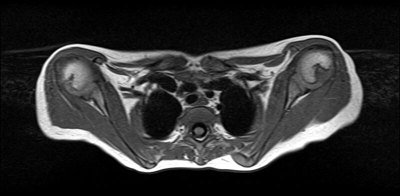 File:Bilateral Sprengel deformity with Klippel-Feil syndrome (Radiopaedia 66395-75650 Axial T1 22).jpg