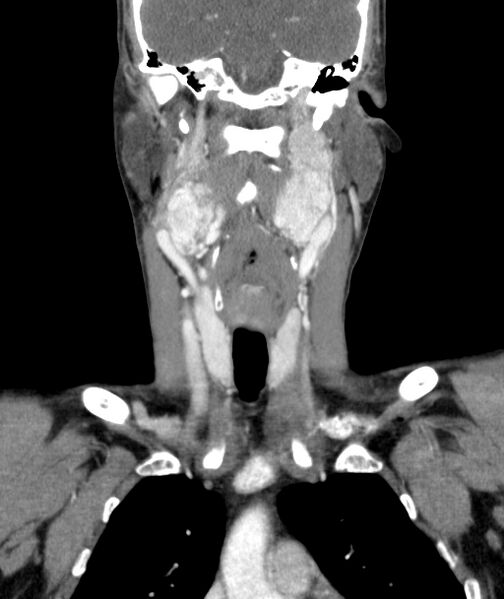File:Bilateral carotid body tumors (Radiopaedia 52899-58827 B 23).jpg
