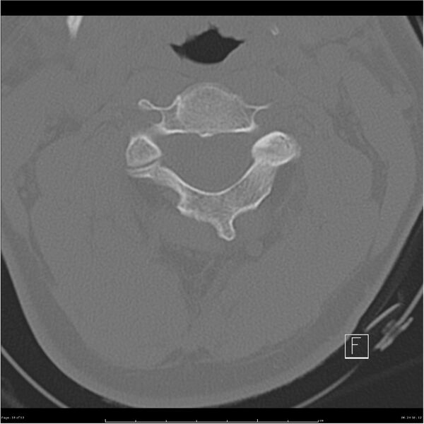 File:Bilateral cervical ribs (Radiopaedia 25868-26017 Axial bone window 18).jpg