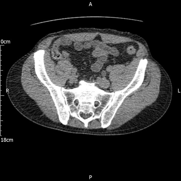 File:Bilateral medullary nephrocalcinosis with ureteric calculi (Radiopaedia 71269-81569 Axial non-contrast 100).jpg