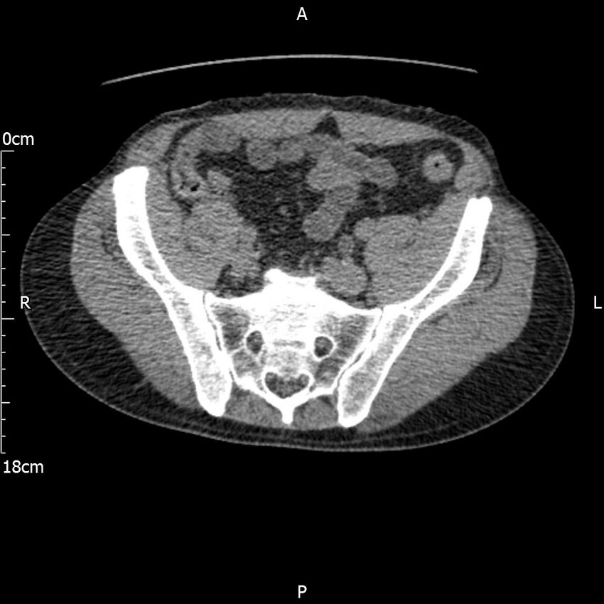 Bilateral medullary nephrocalcinosis with ureteric calculi (Radiopaedia 71269-81569 Axial non-contrast 100).jpg