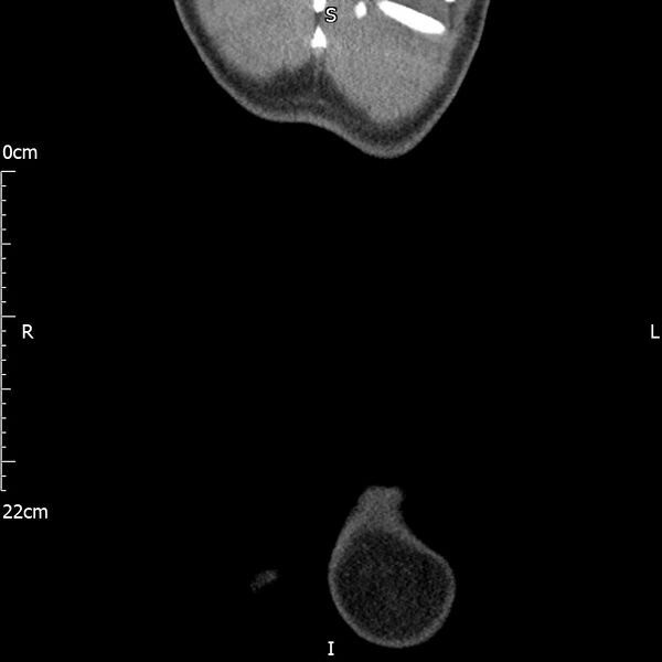 File:Bilateral medullary nephrocalcinosis with ureteric calculi (Radiopaedia 71269-81569 Coronal non-contrast 78).jpg