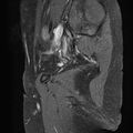 Bilateral ovarian endometriomas (Radiopaedia 87085-103347 F 20).jpg