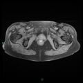 Bilateral ovarian fibroma (Radiopaedia 44568-48293 Axial T1 fat sat 25).jpg
