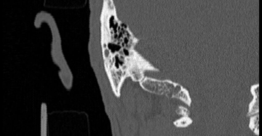 Bilateral temporal bone fractures (Radiopaedia 29482-29970 Coronal non-contrast 164).jpg