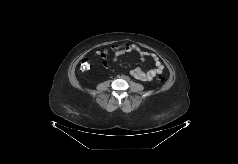 File:Bilateral urolithiasis with incidentally detected splenic artery aneurysm and left inferior vena cava (Radiopaedia 44467-48123 Axial non-contrast 36).jpg