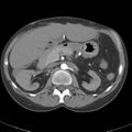 Biliary necrosis - liver transplant (Radiopaedia 21876-21845 A 24).jpg