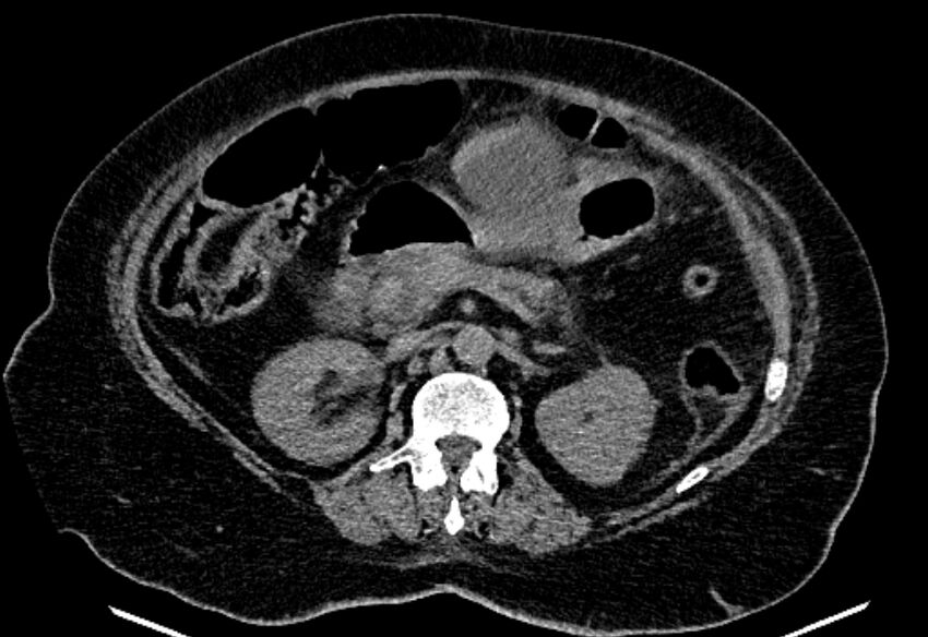 Biliary pancreatitis (Radiopaedia 72289-82823 Axial non-contrast 110).jpg