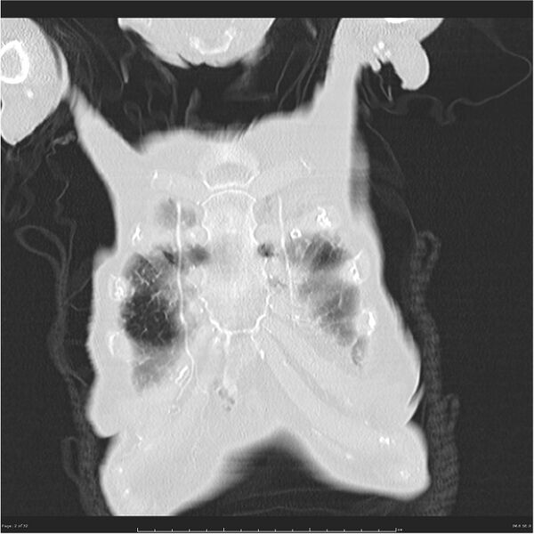 File:Boerhaave syndrome (Radiopaedia 26240-26362 Coronal lung window 2).jpg