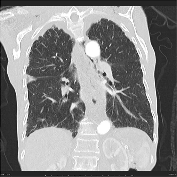 File:Boerhaave syndrome (Radiopaedia 26240-26362 Coronal lung window 21).jpg