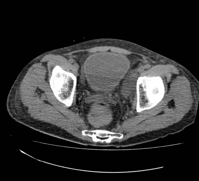 File:Bowel lymphoma complicated by bleeding after therapy (Radiopaedia 55601-62110 Axial non-contrast 73).jpg