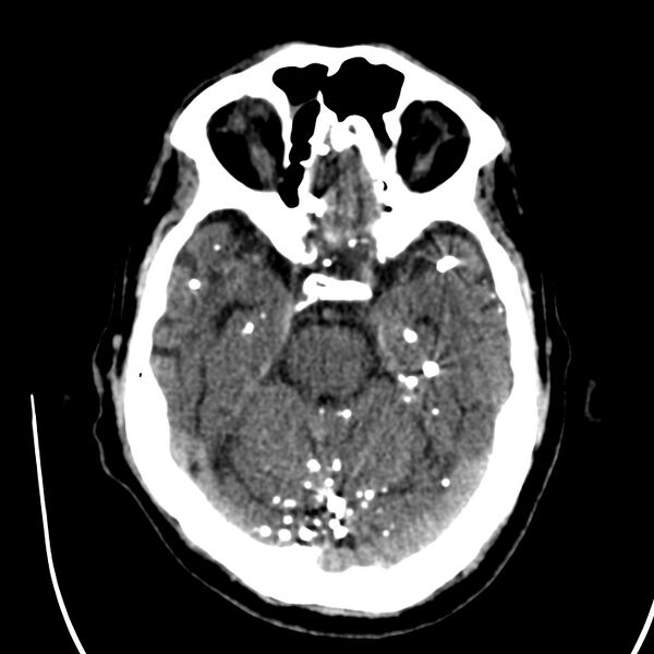File:Brain Pantopaque remnants (Radiopaedia 78403-91048 Axial non-contrast 38).jpg