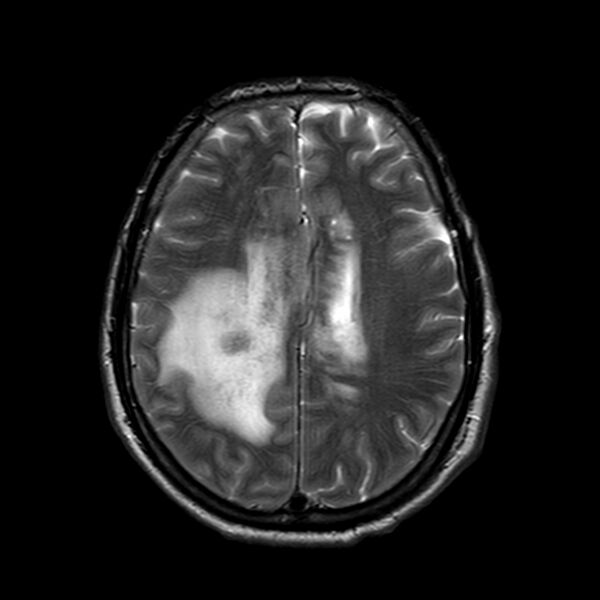 File:Brain abscess complicated by intraventricular rupture and ventriculitis (Radiopaedia 82434-96577 Axial T2 16).jpg