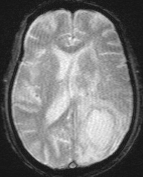 File:Brain abscess with dual rim sign (Radiopaedia 87566-103938 Axial SWI 13).jpg