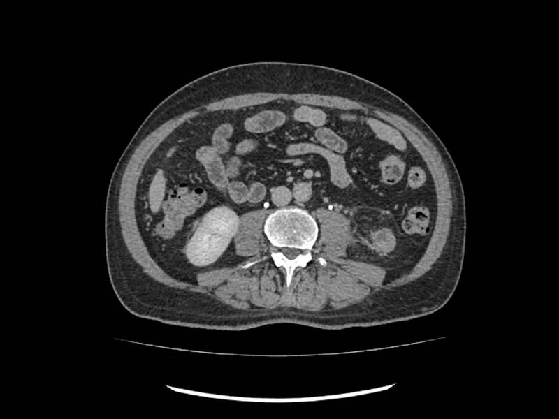 File:Brain metastases from renal cell carcinoma (Radiopaedia 42222-45328 Axial C+ delayed 154).jpg