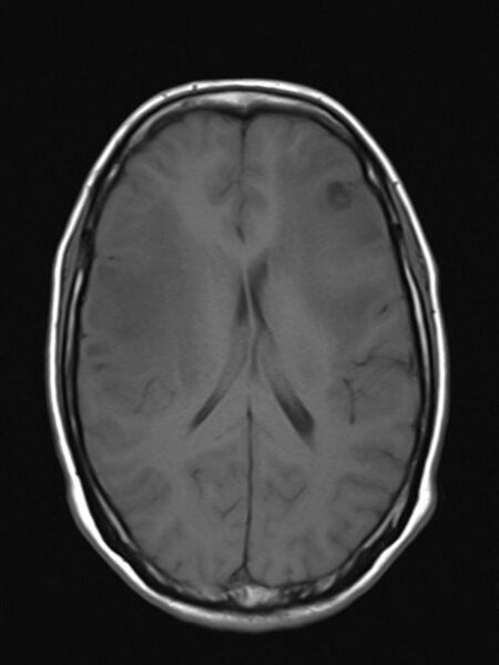 File:Brain metastasis as initial presentation of non-small cell lung cancer (Radiopaedia 65122-74126 Axial T1 12).jpg