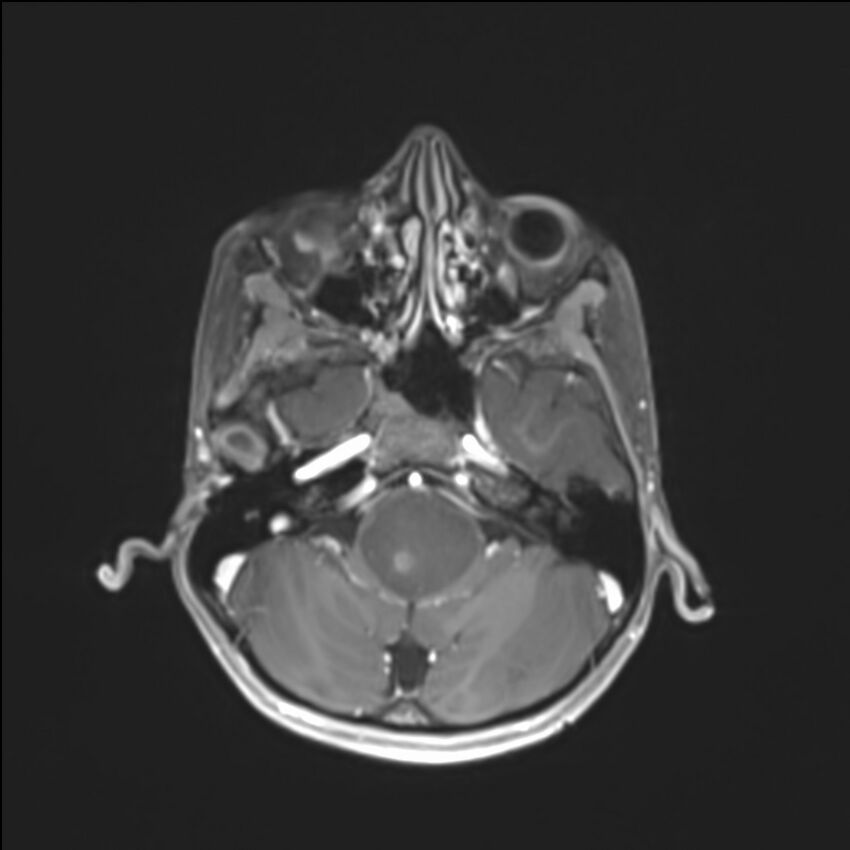 Brainstem glioma (Radiopaedia 70548-80674 Axial T1 C+ 39).jpg