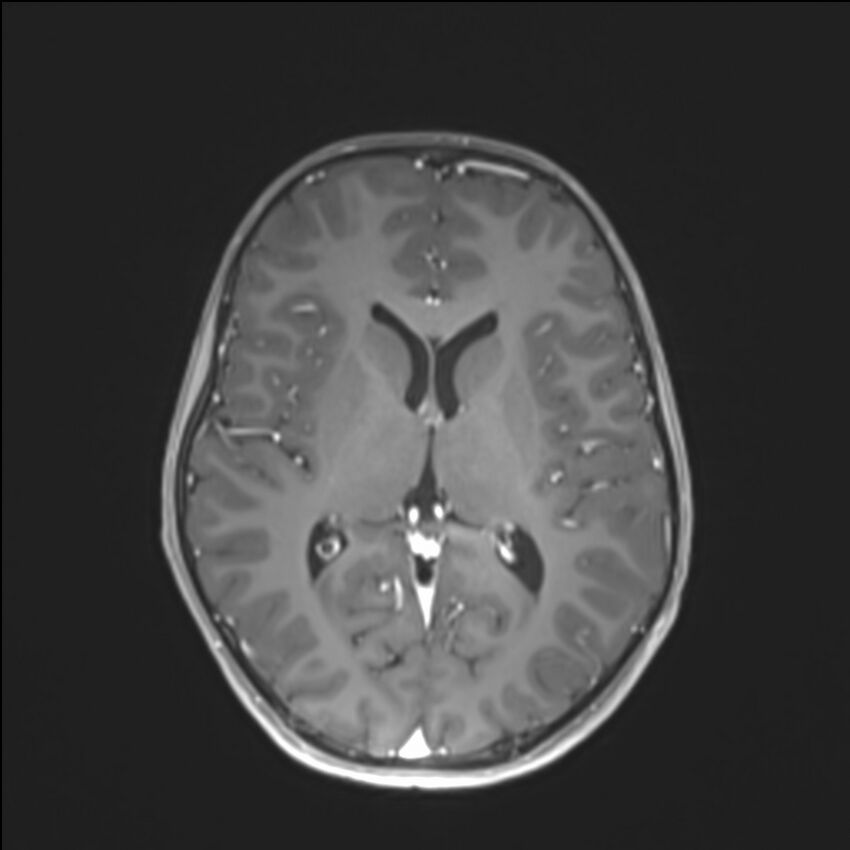 Brainstem glioma (Radiopaedia 70548-80674 Axial T1 C+ 88).jpg