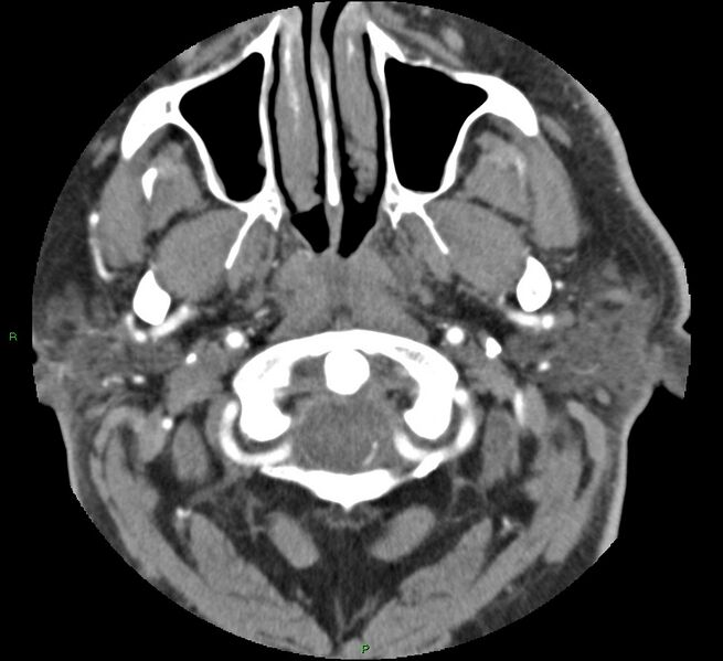 File:Brainstem hemorrhage (Radiopaedia 58794-66028 D 8).jpg